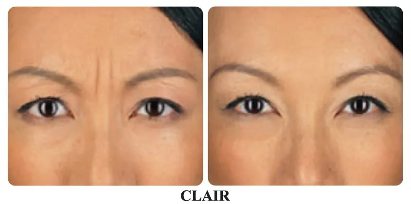 C:\Users\PDD-Sinh\Desktop\ALMa-Q\Before_after_botox_1.jpg