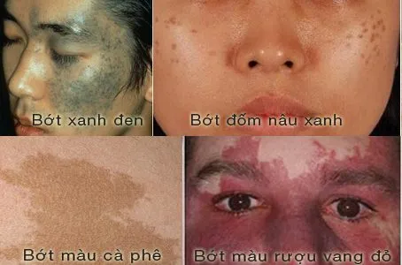 C:\Users\PDD-Sinh\Desktop\ALMa-Q\xoa-vet-bot-laser(1).jpg
