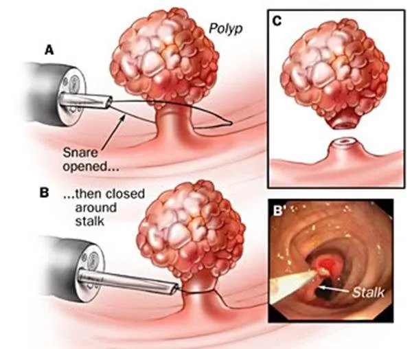 Tổng quan về bệnh polyp đại trực tràng