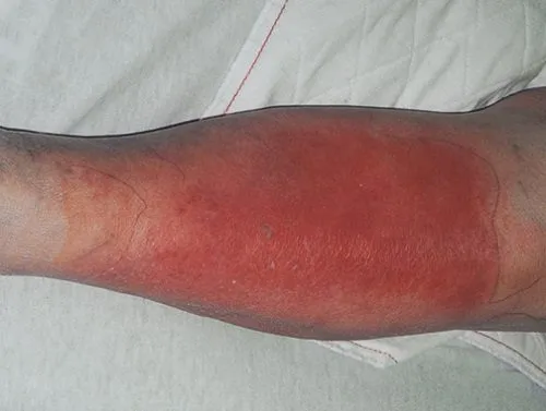 C:\Users\Administrator\Pictures\Viem mo TB 2.jpg