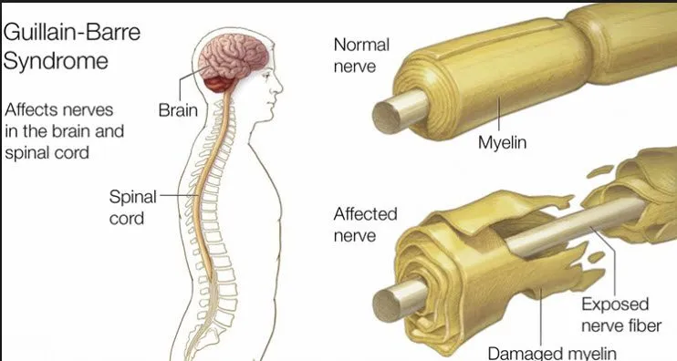 Guillain-Barre Syndrome: Causes, Symptoms, And Treatments