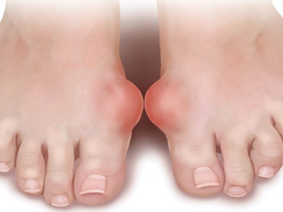 dấu hiệu bệnh gout