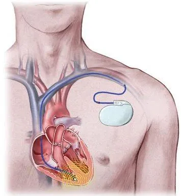 C:\Users\gacon\Desktop\health-enews-ICD-implanted.jpg