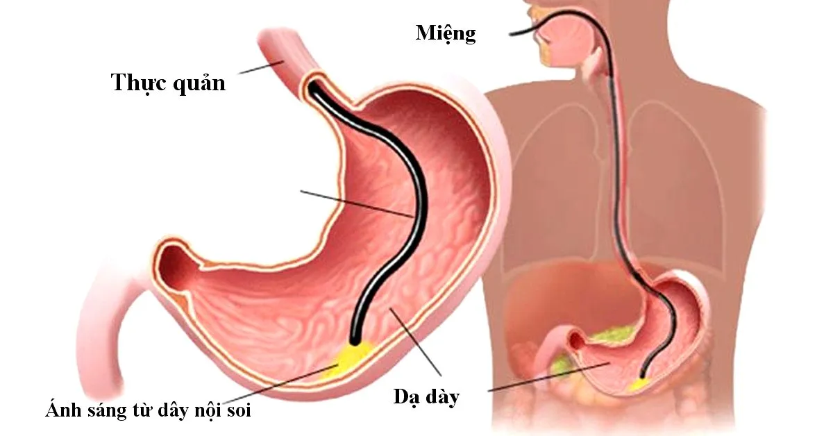 Nội soi dạ dày không đau là gì, quy trình và một số lưu ý