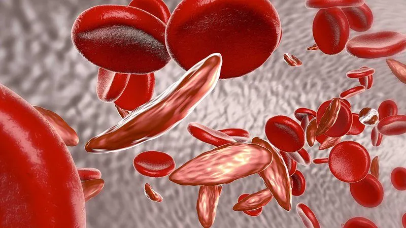 http://www.benhvienbaichay.vn/uploads/news/60965b1b4a718/hong-cau-bat-thuong-benh-thalassemia.jpg