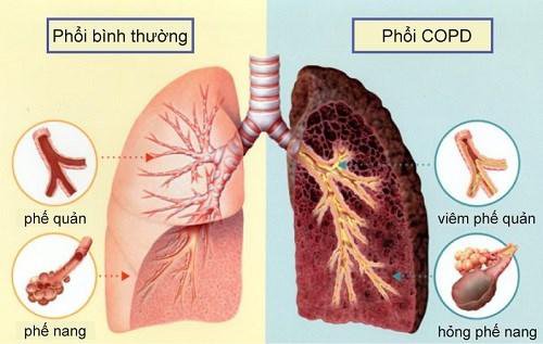 Imaging techniques to evaluate chronic obstructive pulmonary disease (COPD)  | Vinmec