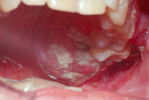 Hình ảnh ung thư miệng có thể được phát hiện sớm