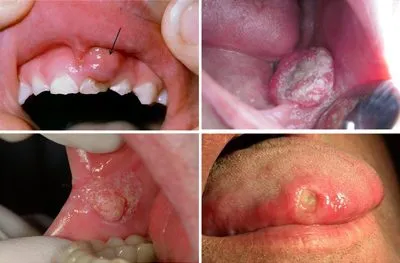 Ung thư khoang miệng: Biểu hiện, điều trị và cách chăm sóc đúng - Ảnh 3.