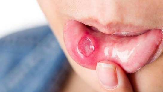 Ung thư miệng giai đoạn đầu rất khó phát hiện do triệu chứng mơ hồ, không đặc hiệu