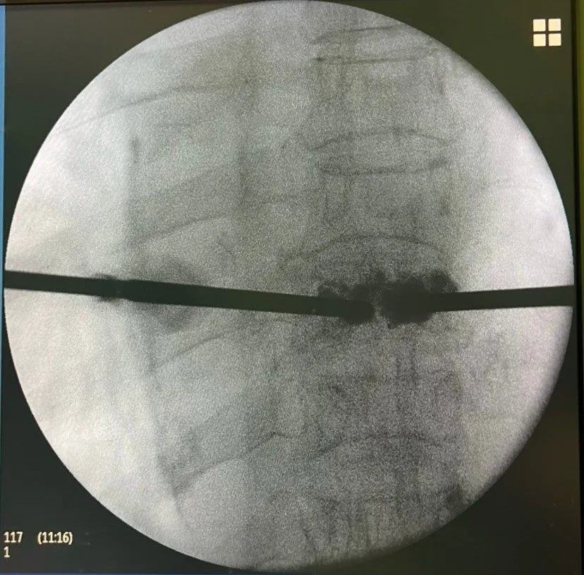 A x-ray of a spine
Description automatically generated