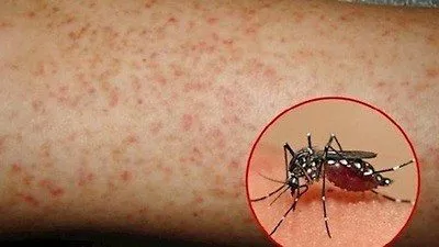 7 dấu hiệu cảnh báo sốt xuất huyết tăng nặng cần đến bệnh viện ngay