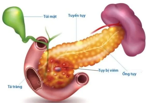 Bệnh viêm tụy cấp