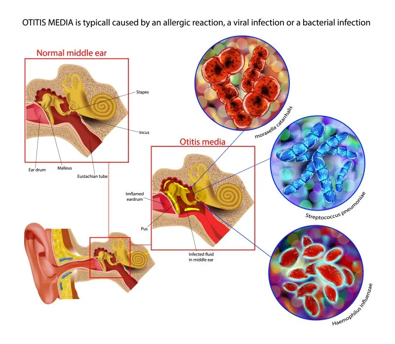 Acute Otitis Media Pathophysiology