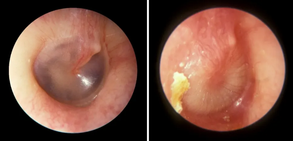 Close-up of the inside of a person's ear

AI-generated content may be incorrect.
